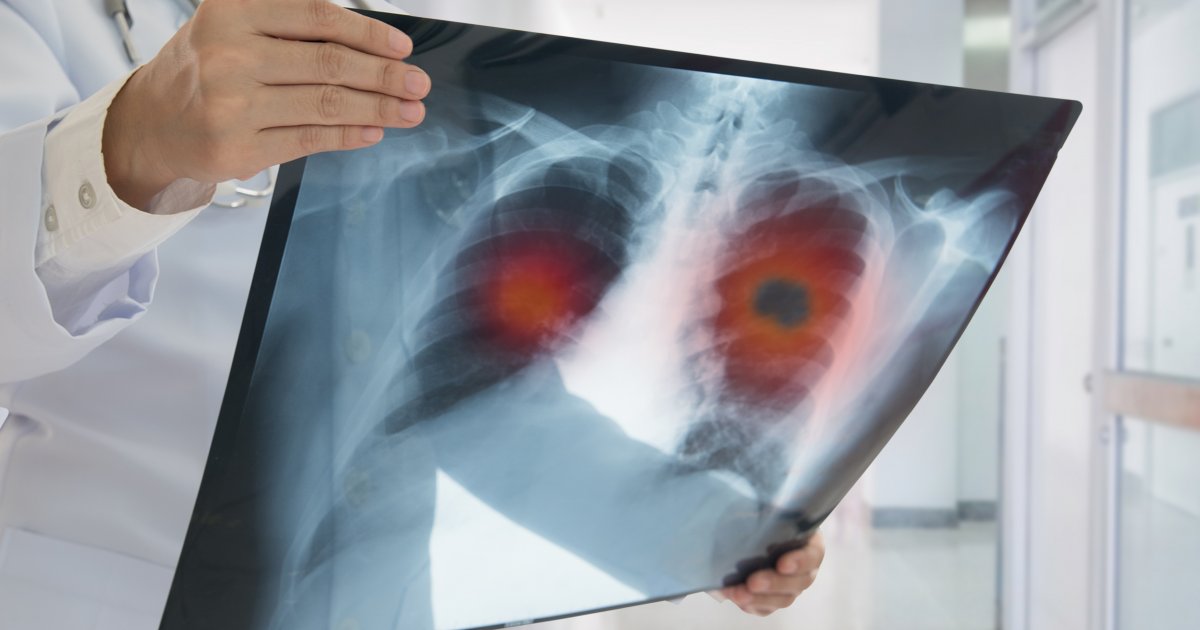 Nova pilula za rak pluća upola smanjuje rizik od umiranja - Telegraf.rs
