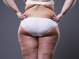 Prekomerna težina, debela žena, noge, celulit, žensko telo, gojaznost