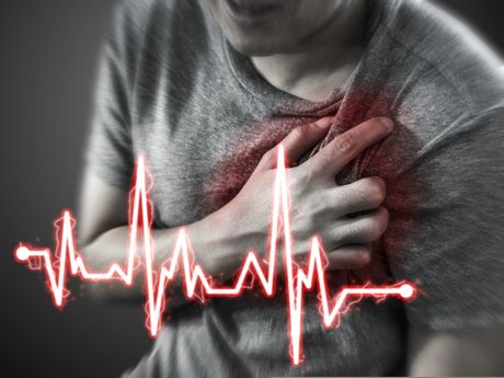 Srcani udar, infarkt. srce, pritisak, bol u grudima, ekg Srcani udar, infarkt. srce, pritisak, bol u grudima, ekg