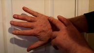 Neobičan simptom na vrhovima prstiju može da ukaže na najsmrtonosniji oblik raka: Obratite pažnju na ovo