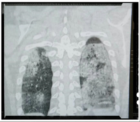 snimak pluća pacijenta zaraženog koronom; foto Facebook/Dragan Stevanovic snimak pluća pacijenta zaraženog koronom; foto Facebook/Dragan Stevanovic