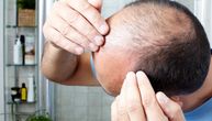 Nova otkrića o gubitku kose kod muškaraca