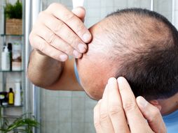 Gubljenje gubitak kose ćelavljenje