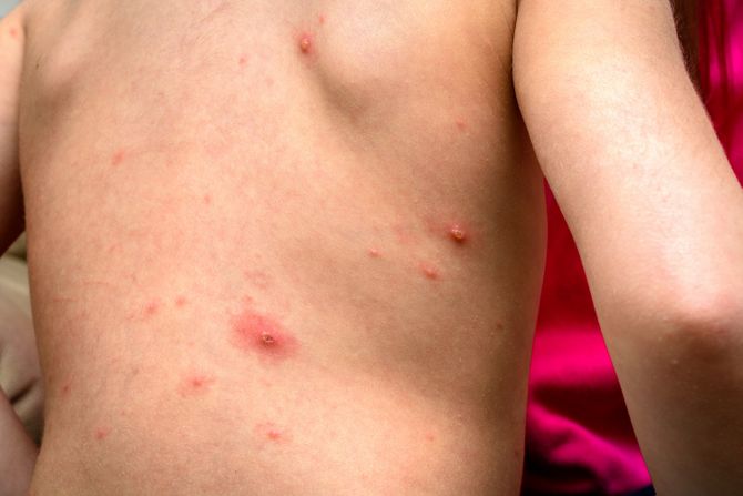 Varicella zoster virus varičela ovčije boginje dete osip Varicella zoster virus varičela ovčije boginje dete osip