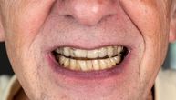 Svaka šesta odrasla osoba u Srbiji nema sve svoje zube: Stomatolozi upozoravaju na jedno