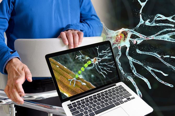 amiotrofična lateralna skleroza, fizioterapeut, Neuroni, bolesti neurona, neurodegenerativna bolest, laptop