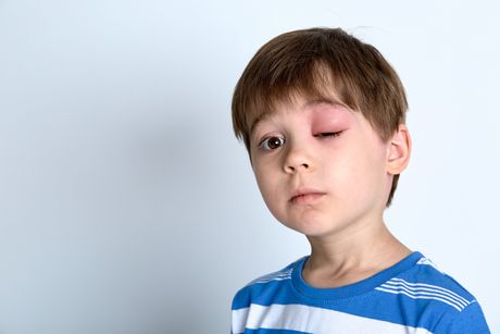 Boy swollen eye dečak otečeno oko