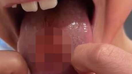 Deca jezik slatkiš povreda