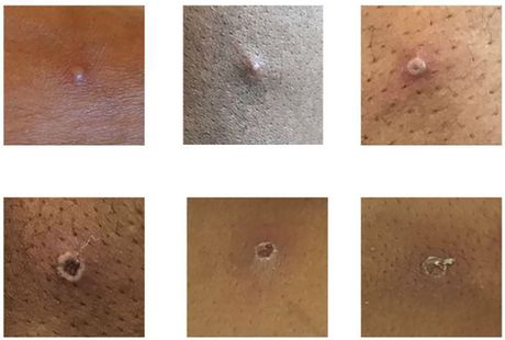 Monkeypox, majmunske boginje