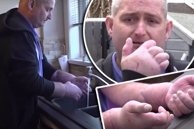 Ruke transplantacija Steven Gallagher scleroderma Ruke transplantacija Steven Gallagher scleroderma