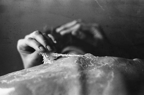 Ljuštenje kože, opekotine od sunca