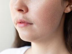 Devojka, brokovi, maljavost, dlake, hirzutizam