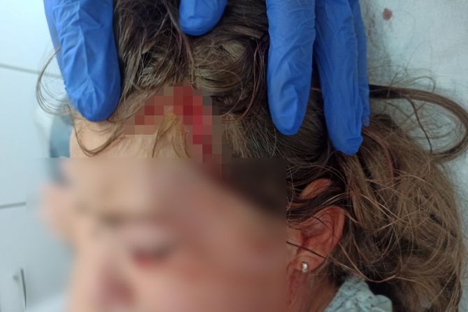 Prijepolje devojčica koju je napao pit bul Prijepolje devojčica koju je napao pit bul