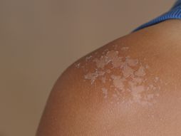 Izgorela koža od sunca