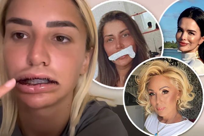 Usne silikoni Dalila Aleksandra Nikolić Brena Severina Usne silikoni Dalila Aleksandra Nikolić Brena Severina