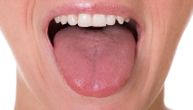 Neobičan znak na jeziku može značiti nedostatak vitamina B12, upozorava doktor