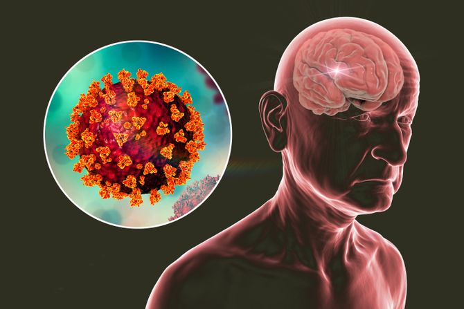 korona, demencija, mozak, korona virus korona, demencija, mozak, korona virus