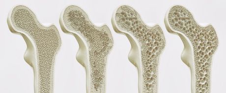 Kosti, osteoporoza