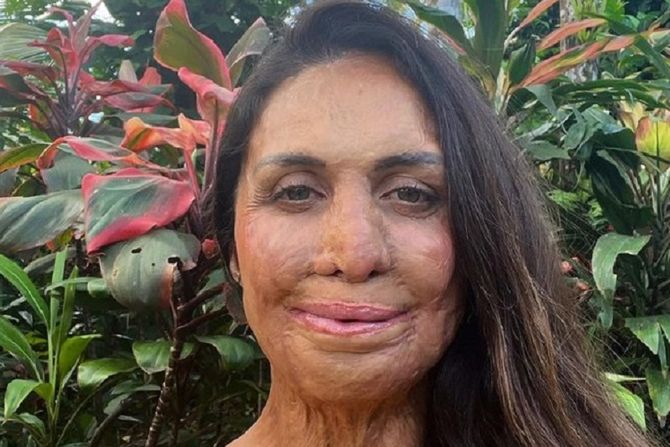 Turia Pitt