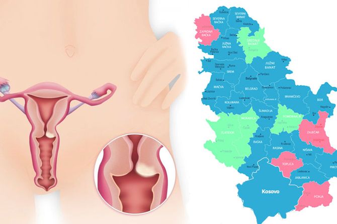 Okruzi gde se najviše i najmanje umire od raka grlića materice