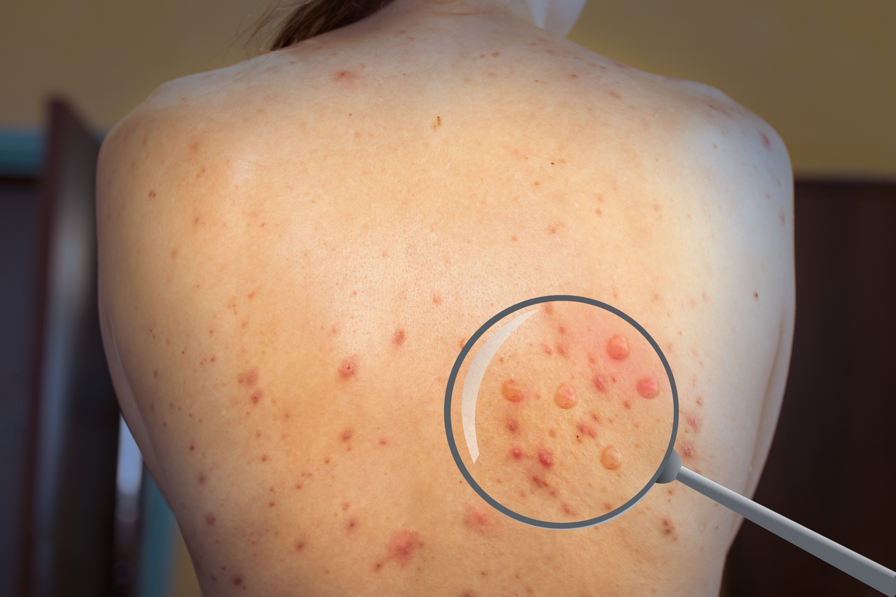 Smrtonosan virus se širi u našem komšiluku: Čak 446 zaraženih među kojima je najviše dece