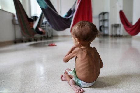 Brazil neuhranjenost glad deca mršavo dete