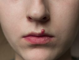 bubuljice, akne, bubuljice na usni, usne