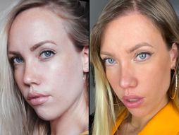 Sonja, transplantacija kose