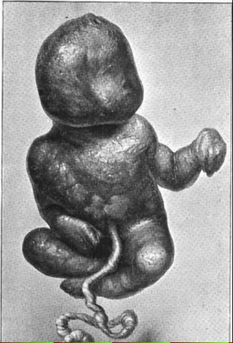 Calcified fetus (lithopedion)