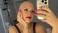 Sa 22 godine je dobila alopeciju, a sa perikom se čak i kupala: Sada se oseća snažno i lepo