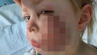 Devojčica (4) zbog napada psa završila sa 40 šavova na licu: "Paničila sam i plakala, bila je gomila krvi..."