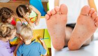 Američki virus kosi decu u vrtićima: Napada ruke, noge i usta, a počinje temperaturom