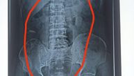 Doktori kad su videli rendgen, nisu mogli da veruju šta je u stomaku čoveka: Morali su odmah da ga operišu