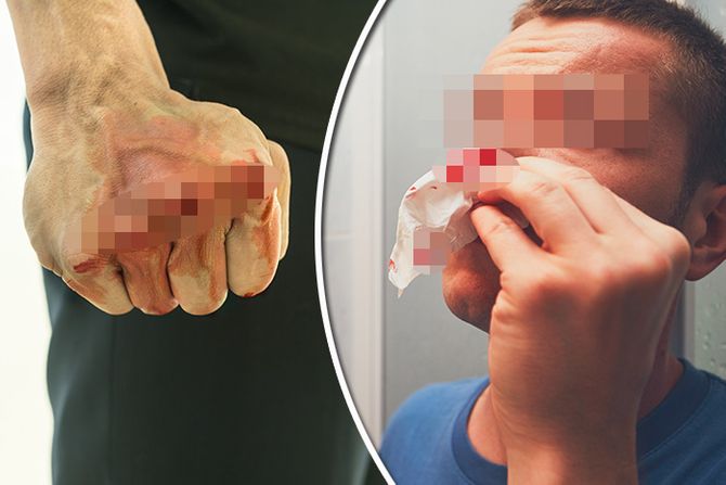 Nasilje napad slomljen polomljen nos Nasilje napad slomljen polomljen nos