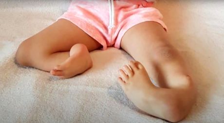 Devojčica noge operacija Engleska Devojčica noge operacija Engleska