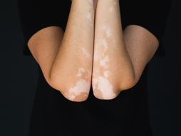 Vitiligo