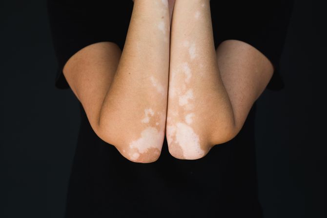 Vitiligo