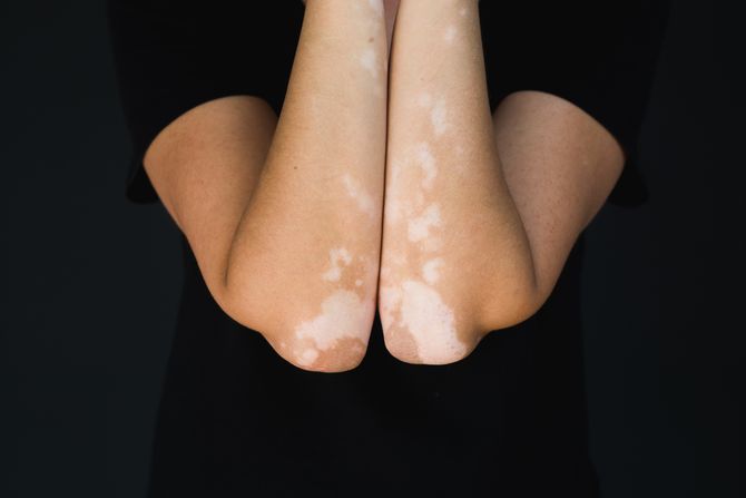 Vitiligo Vitiligo