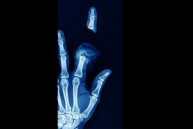 operacija, operaciona sala