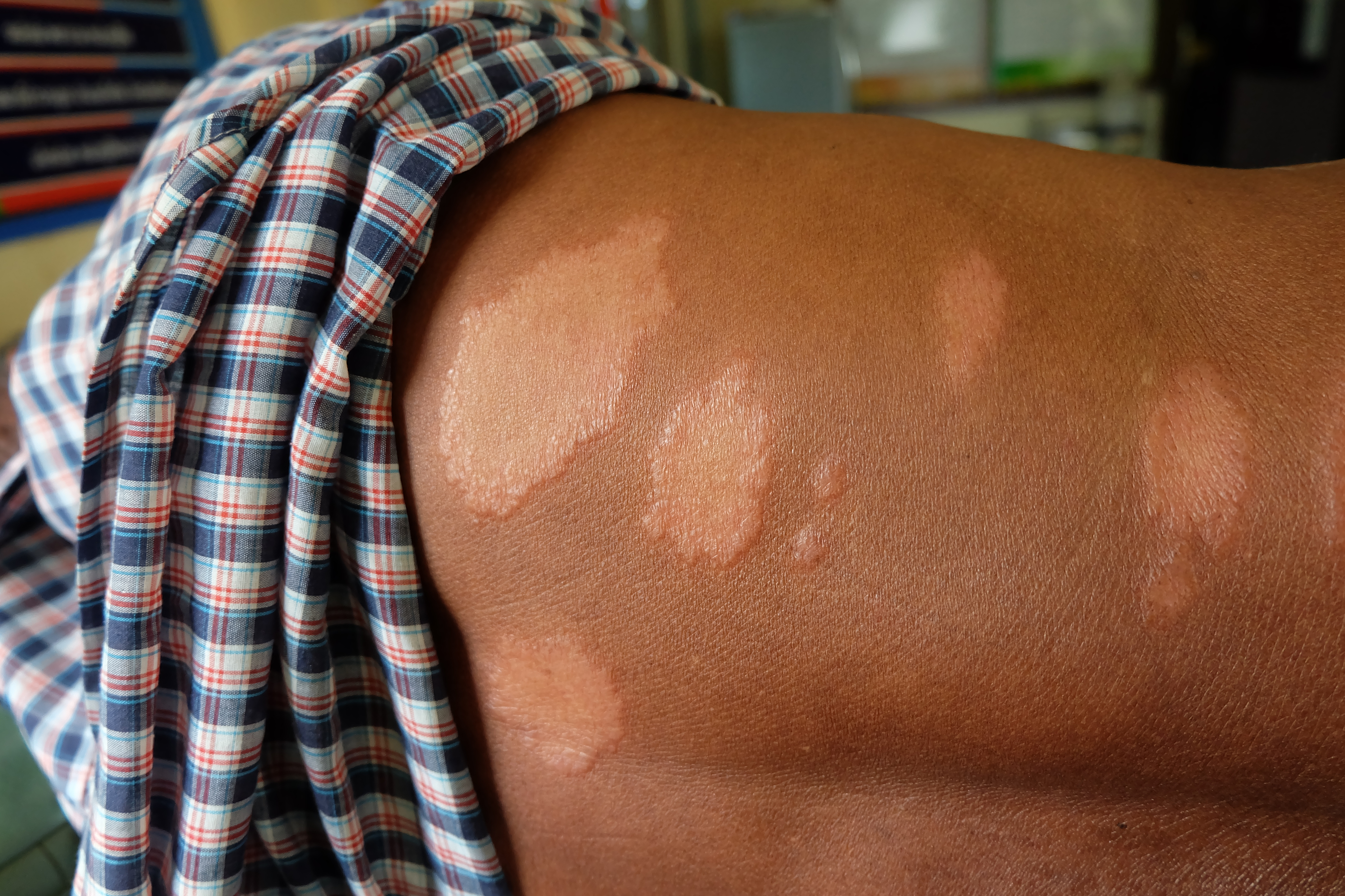 Objavljeno stanje radnika zaraženog gubom u Hrvatskoj: "Rizik širenja je vrlo malen"