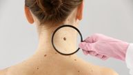 Kako da prepoznate da li imate melanom ili pege od sunčevih zraka