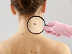 melanom, mladež, koža, dermatologija