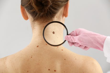 melanom, mladež, koža, dermatologija melanom, mladež, koža, dermatologija