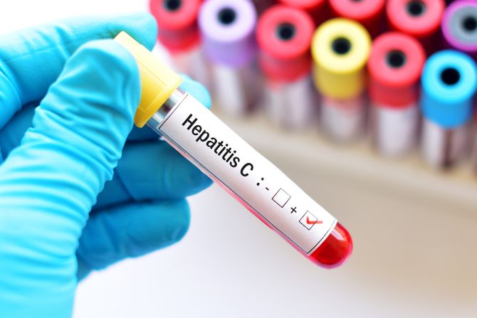 hepatitis