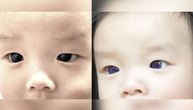 Oči bebe postale indigo plave nakon što joj je dat lek protiv kovida-19, zabeleženo još sličnih slučajeva