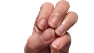 Brazde po noktima: Da li nam pokazuju zdravstveno stanje, zašto ih dobijamo i kako da ih se rešimo?