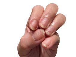 nokti, brazde po noktima, linije po noktima