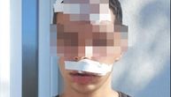 Dečaka pretukla grupa maloletnika u Belegišu: Gubio je svest, završio u bolnici, ušivali mu glavu i usnu