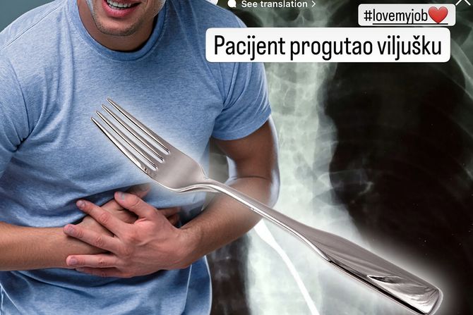 Rendgen pacijent progutao viljušku viljuška Fičer