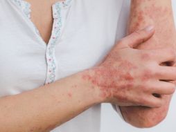 Psorijaza